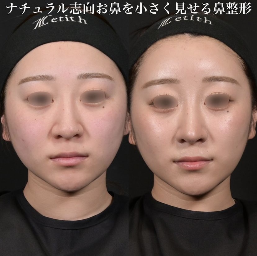 鉄医師による鼻整形の施術前／施術後3ヶ月