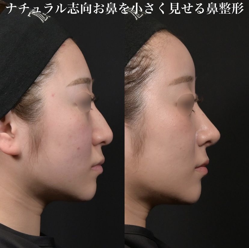 鉄医師による鼻整形の施術前／施術後3ヶ月 术后 