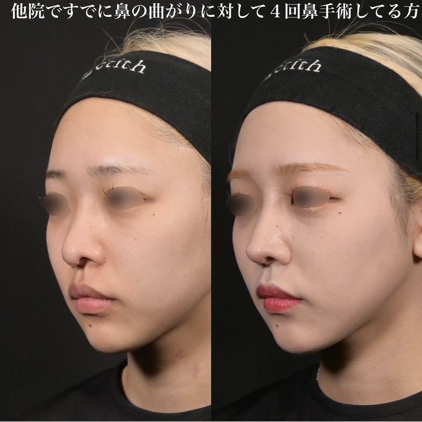 鉄医師による鼻整形の施術前／施術後1ヶ月