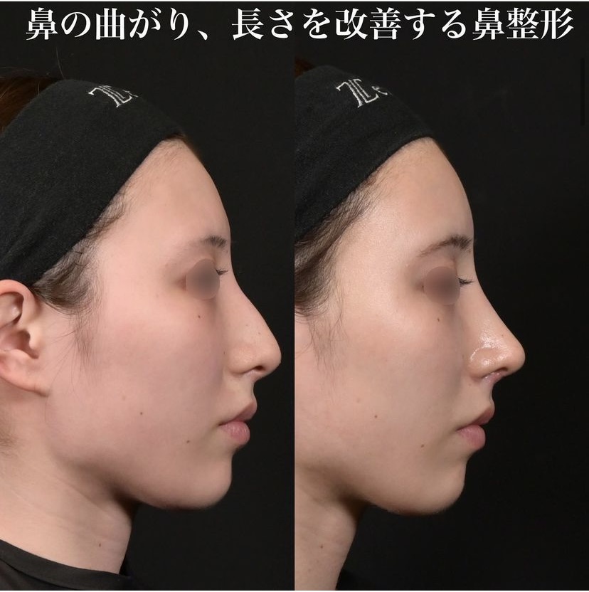 鉄医師による鼻整形の施術前／施術後1ヶ月
