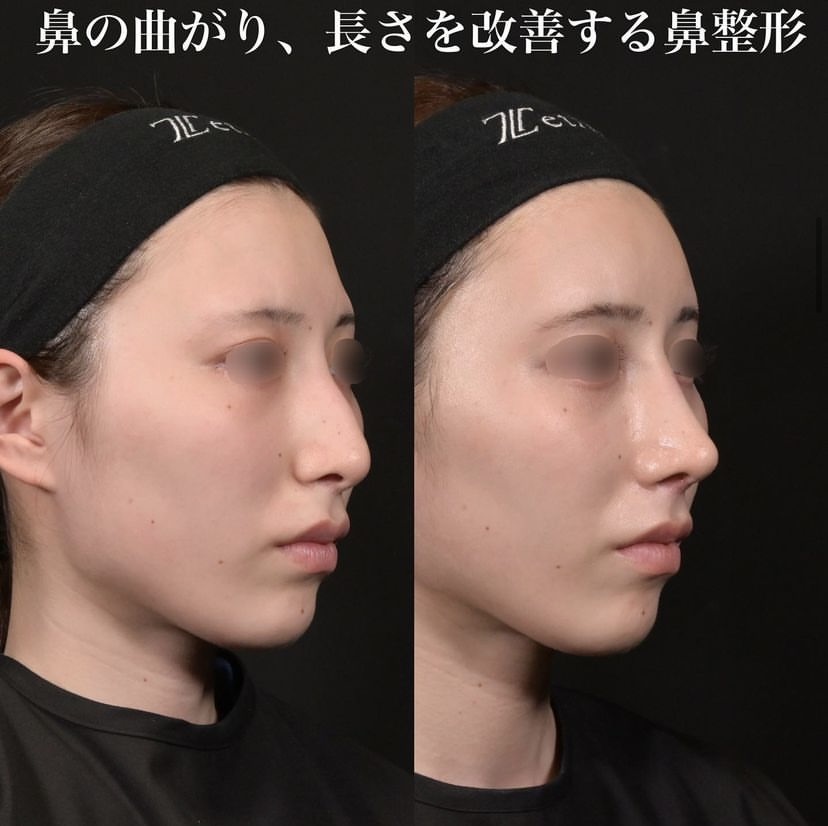 鉄医師による鼻整形の施術前／施術後1ヶ月 施術後 