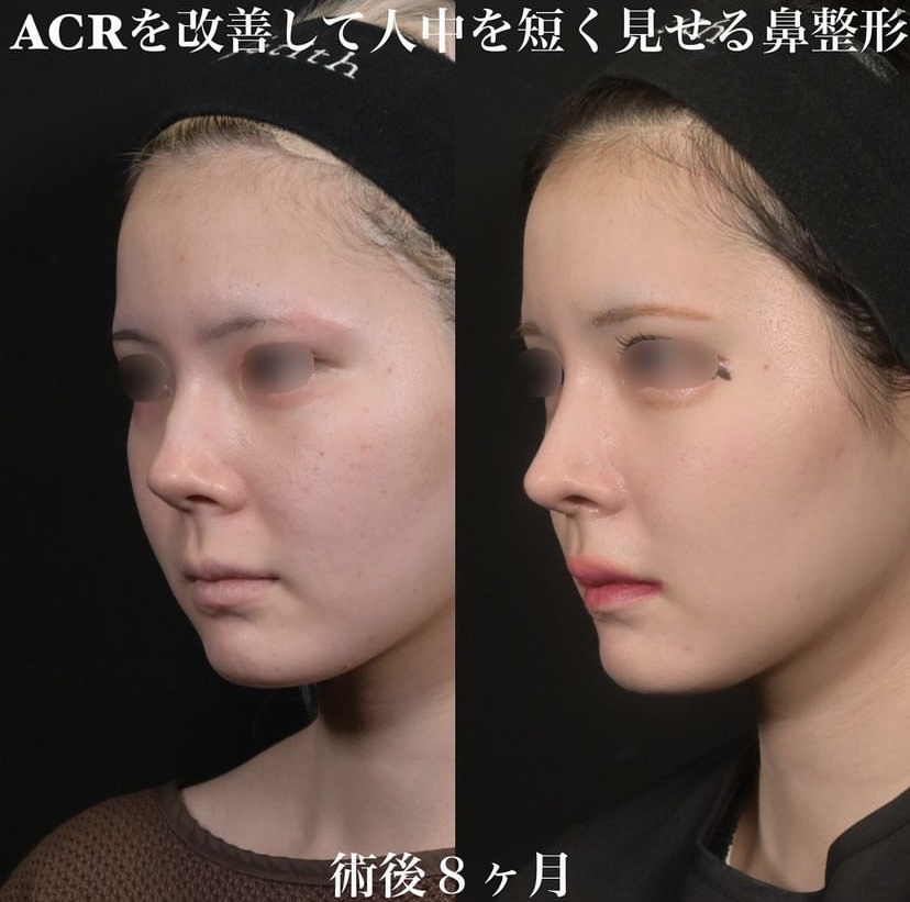 鉄医師による鼻整形の施術前／施術後8ヶ月