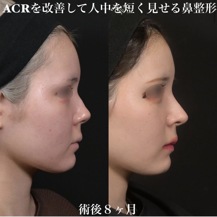 鉄医師による鼻整形の施術前／施術後8ヶ月 หลัง 
