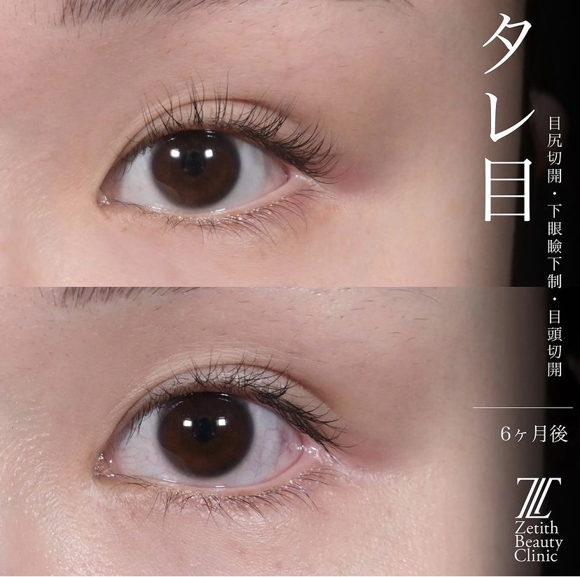 上木原医師による目元整形の施術前／施術後6ヶ月