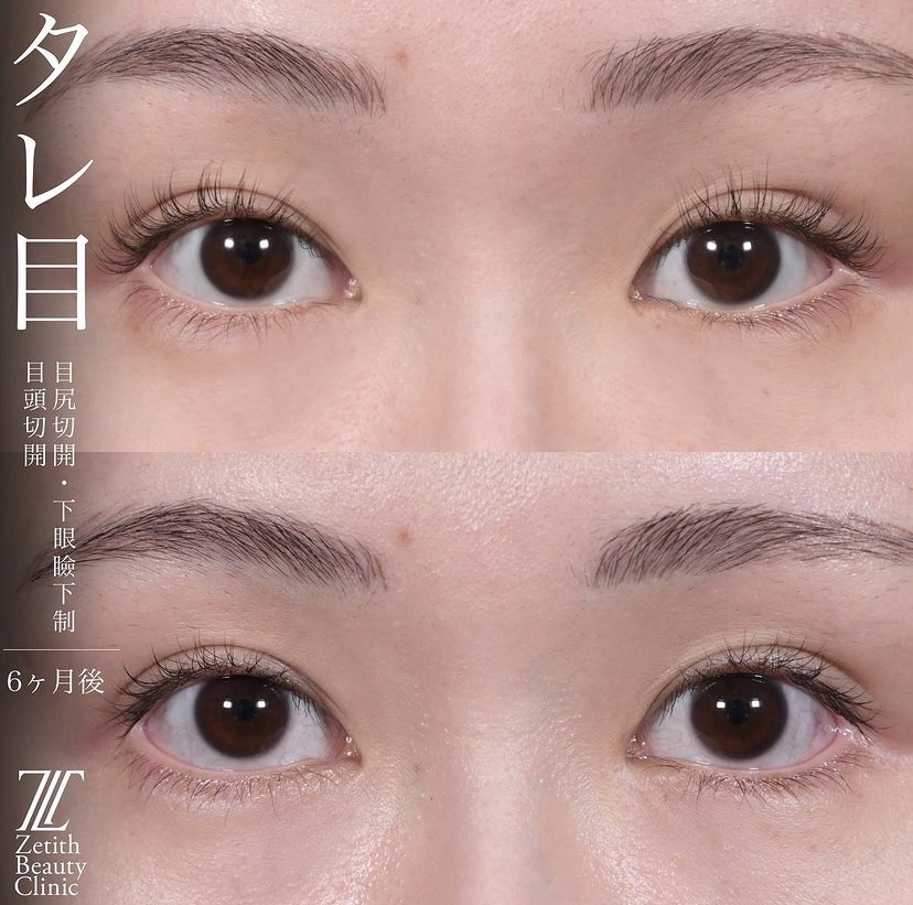 上木原医師による目元整形の施術前／施術後6ヶ月 施術後 