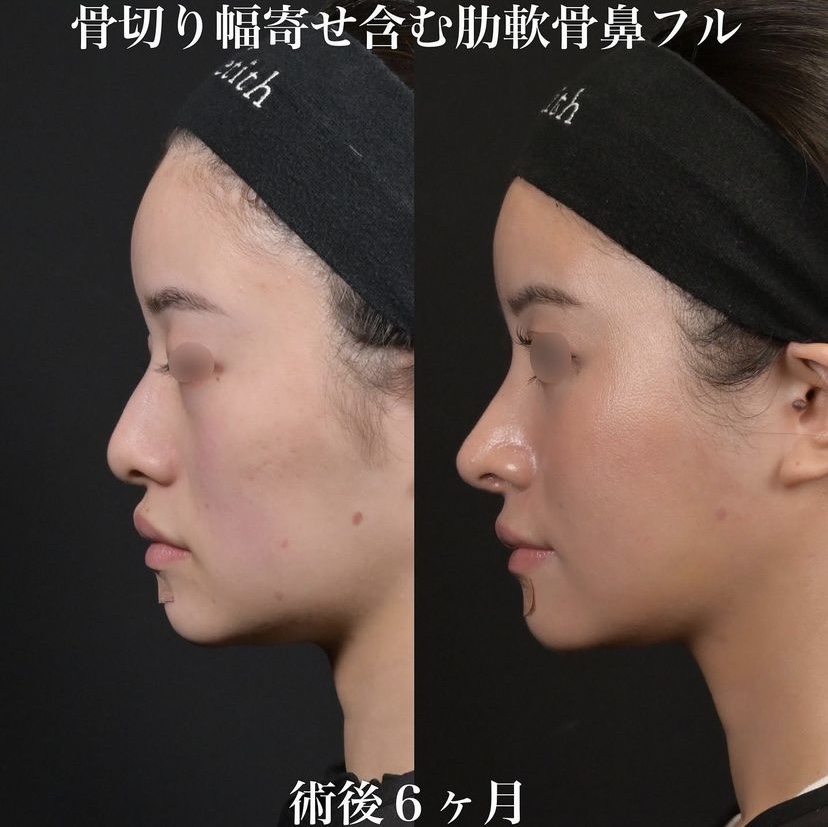 鉄医師による鼻整形の施術前／施術後6ヶ月