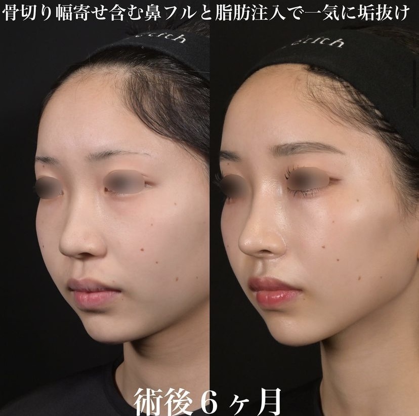 鉄医師による鼻整形の施術前／施術後6ヶ月