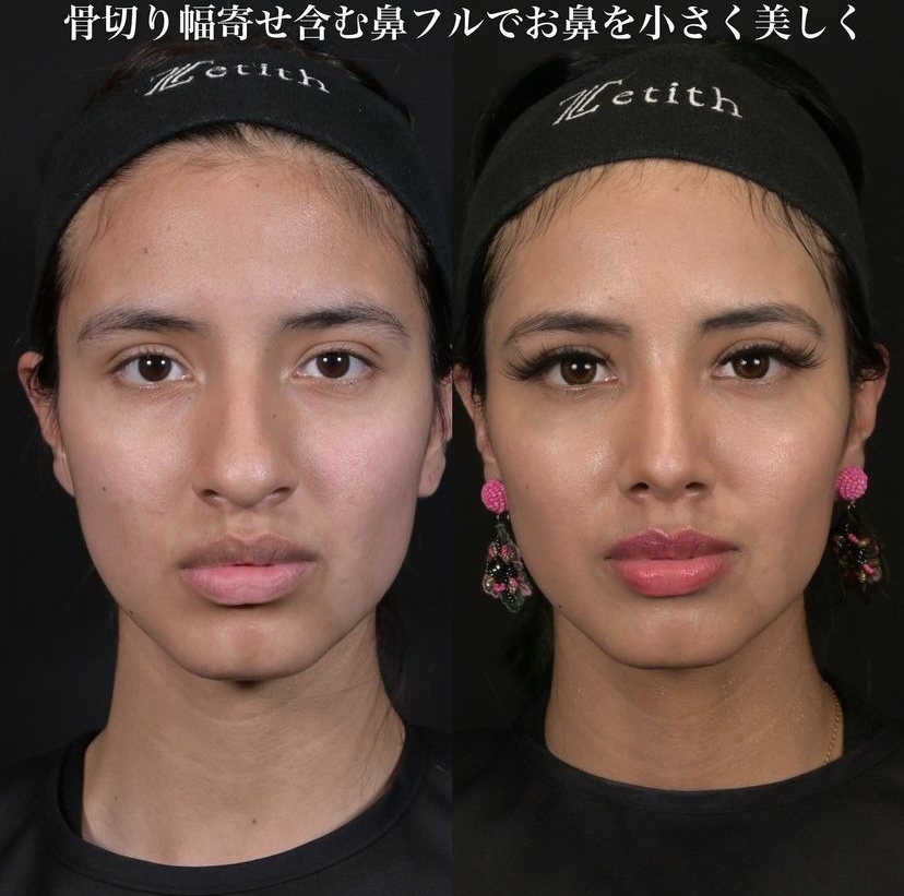 鉄医師による鼻整形の施術前／施術後3ヶ月