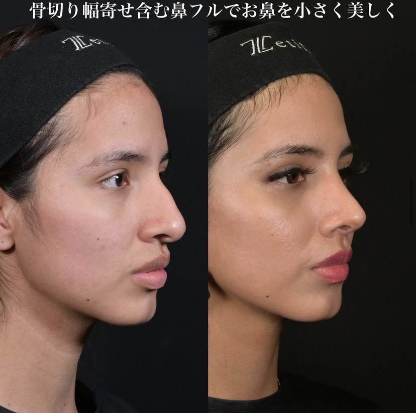 鉄医師による鼻整形の施術前／施術後3ヶ月 施術後 