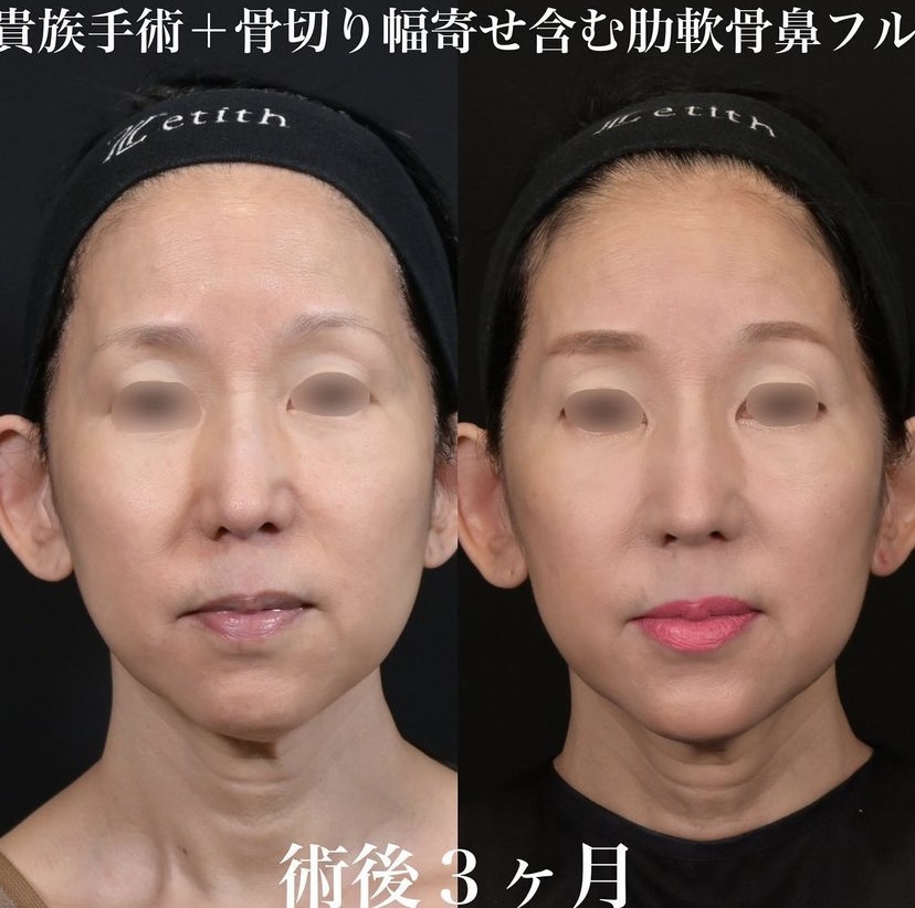 鉄医師による鼻整形の施術前／施術後3ヶ月