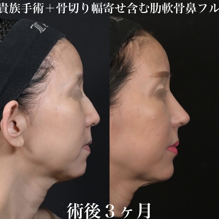 鉄医師による鼻整形の施術前／施術後3ヶ月 After 