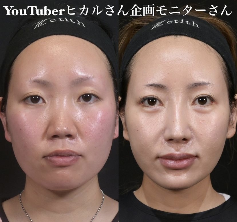 鉄医師による鼻整形の施術前／施術後6ヶ月