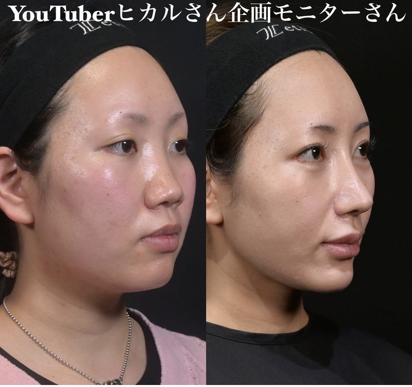鉄医師による鼻整形の施術前／施術後6ヶ月 施術後 