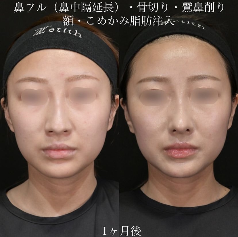 上木原医師による鼻整形の施術前／施術後1ヶ月