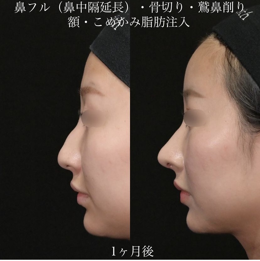 上木原医師による鼻整形の施術前／施術後1ヶ月 Дараа 