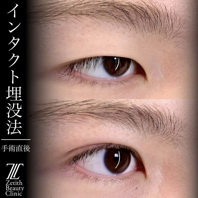 上木原医師による埋没法の施術前／施術直後