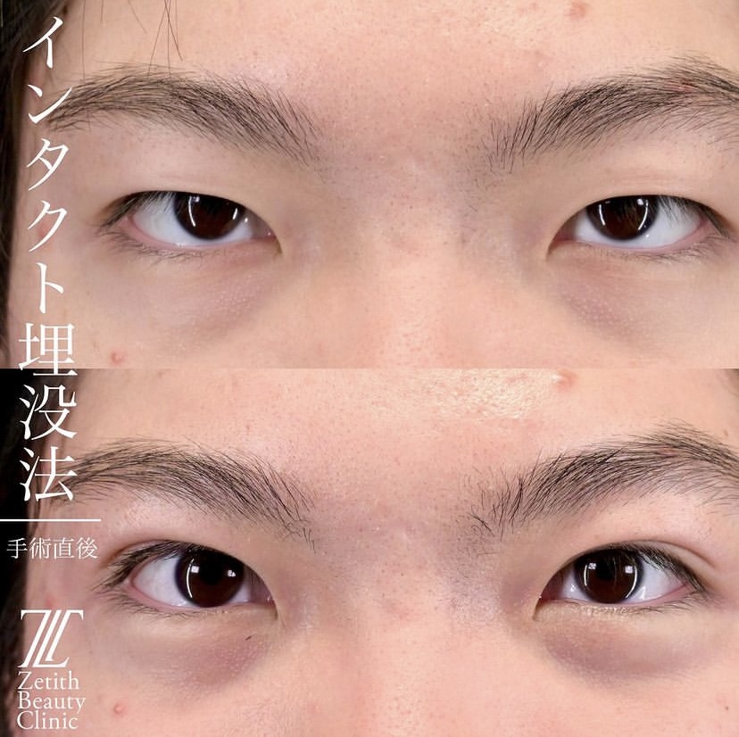 上木原医師による埋没法の施術前／施術直後 Дараа 
