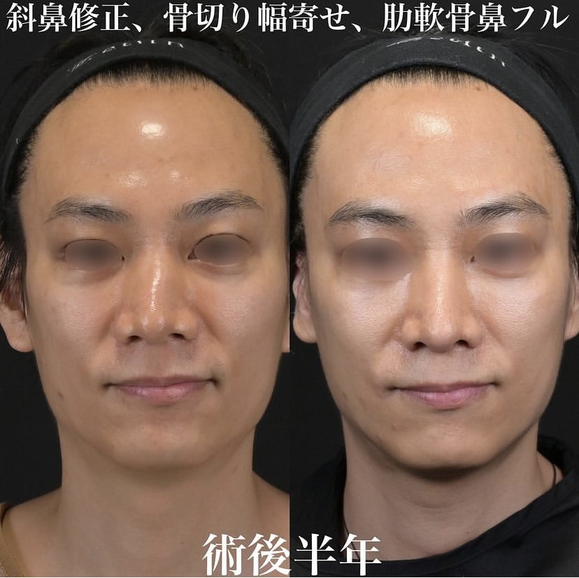 鉄医師による鼻整形の施術前／施術後6ヶ月