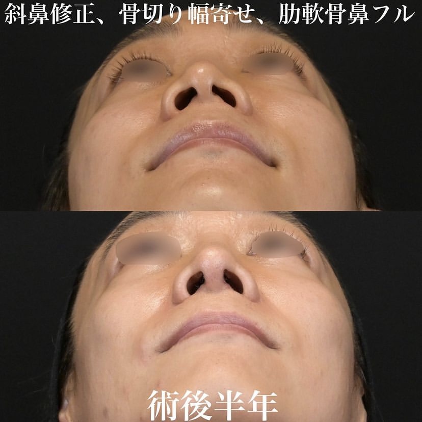 鉄医師による鼻整形の施術前／施術後6ヶ月 施術後 