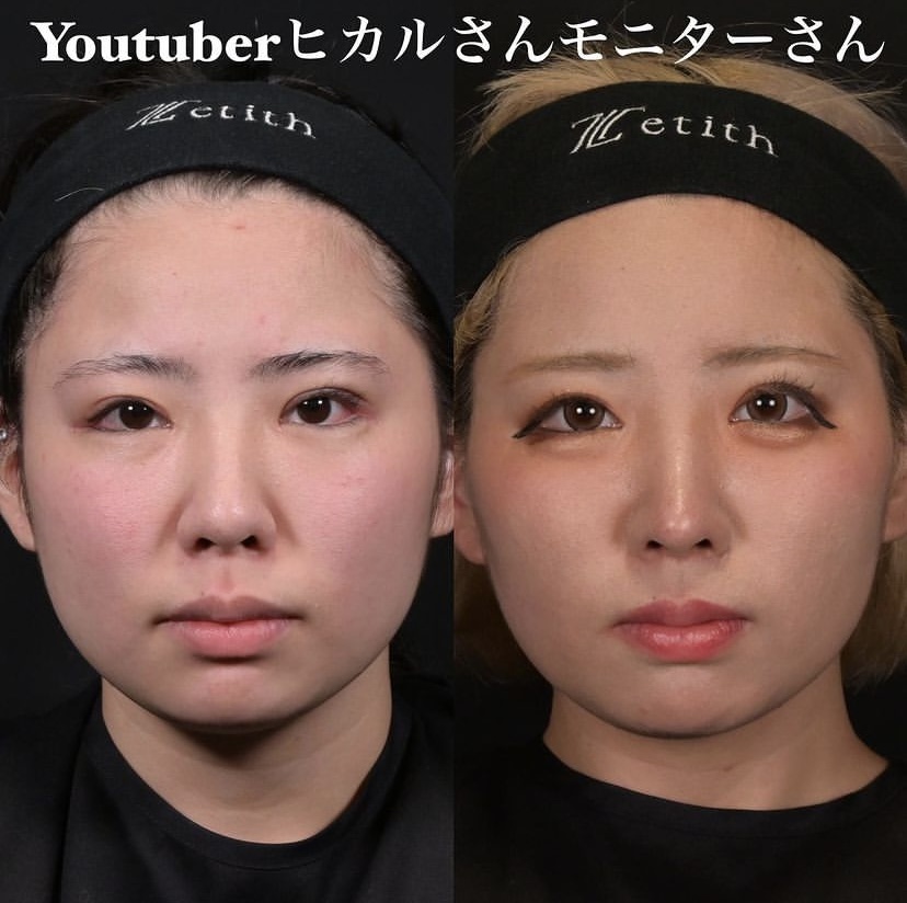 鉄医師による鼻整形の施術前／施術後6ヶ月