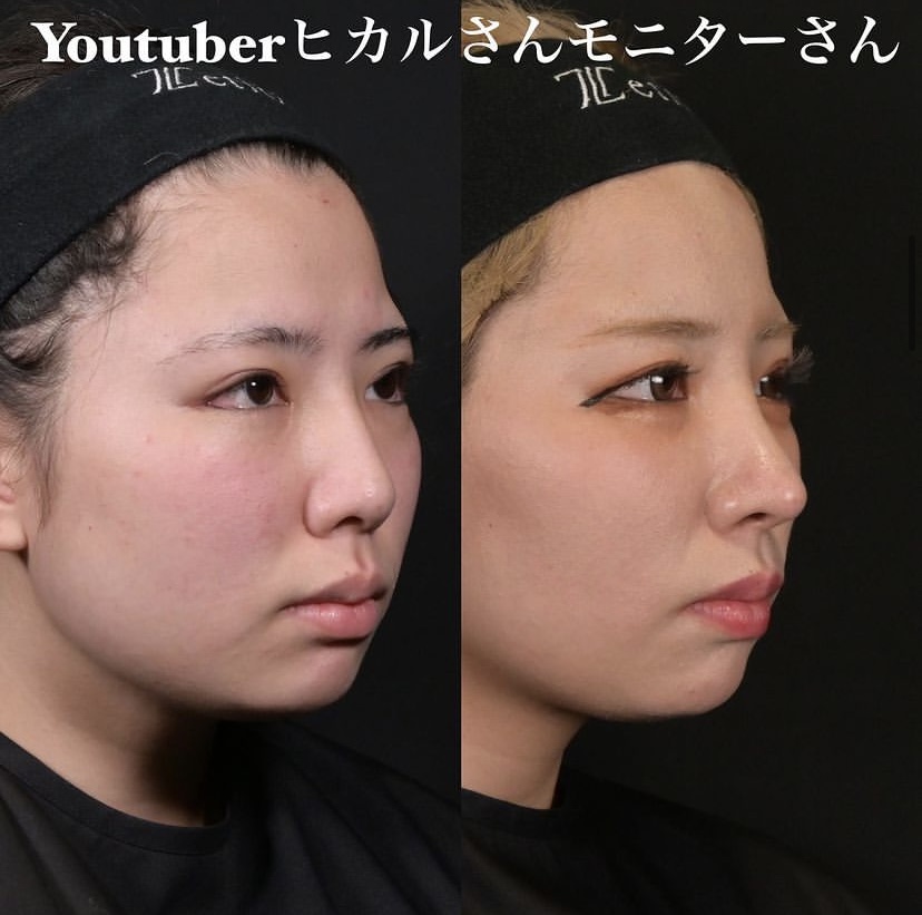 鉄医師による鼻整形の施術前／施術後6ヶ月 After 