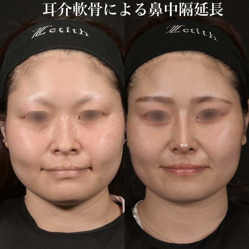 鉄医師による鼻整形の施術前／施術後1ヶ月