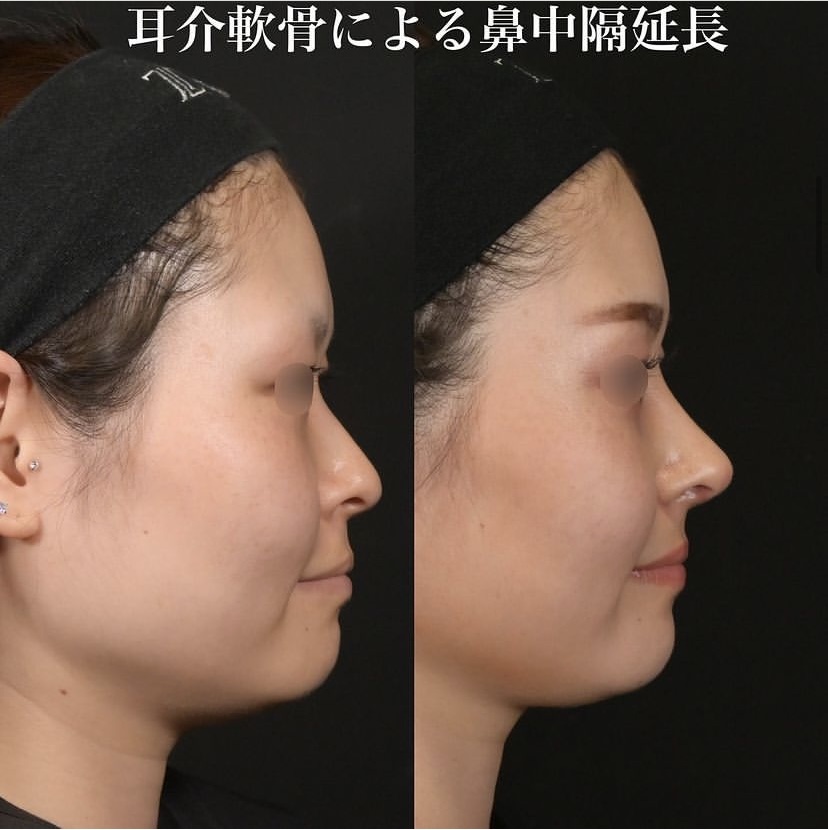 鉄医師による鼻整形の施術前／施術後1ヶ月 施術後 