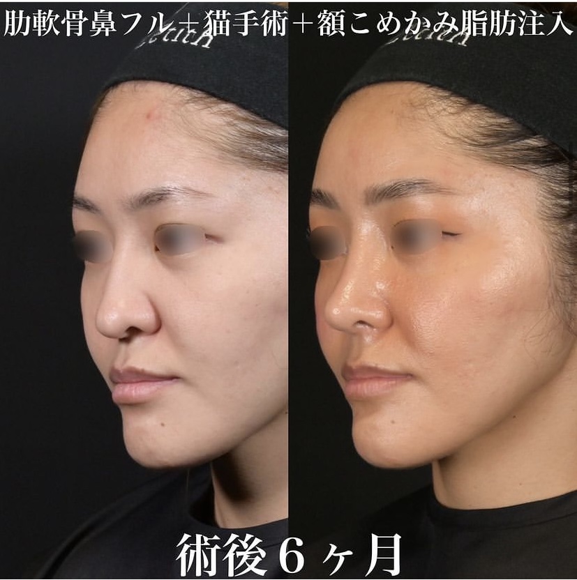 鉄医師による鼻整形の施術前／施術後6ヶ月