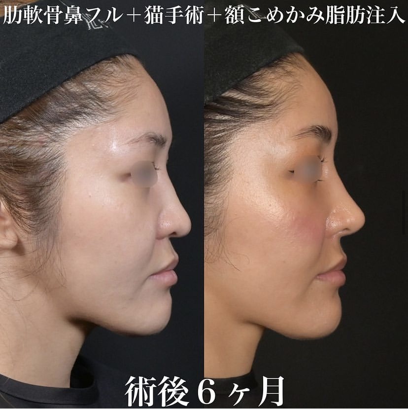 鉄医師による鼻整形の施術前／施術後6ヶ月 术后 
