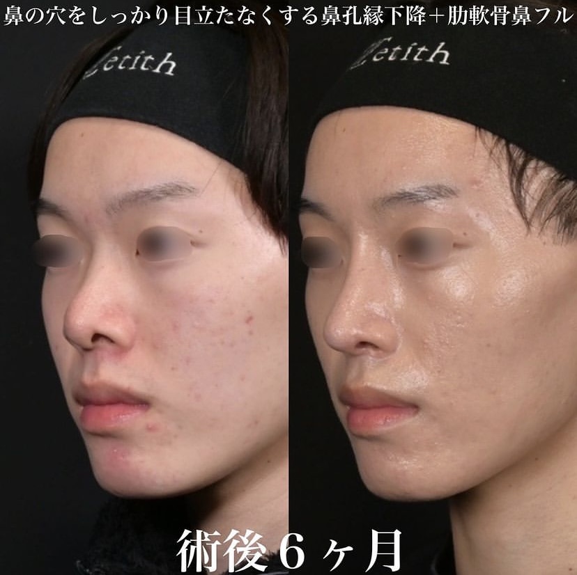 鉄医師による鼻整形の施術前／施術後6ヶ月