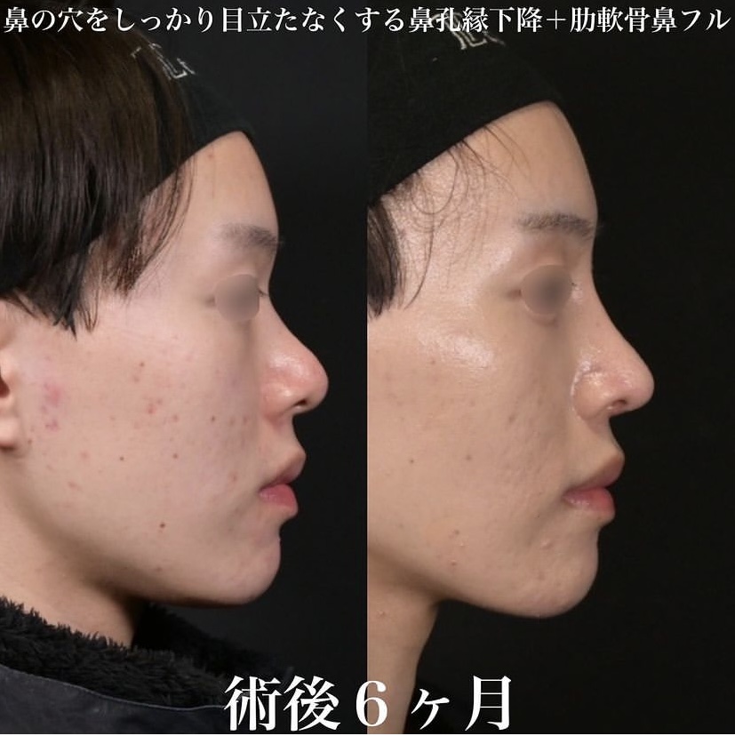 鉄医師による鼻整形の施術前／施術後6ヶ月 Sonra 