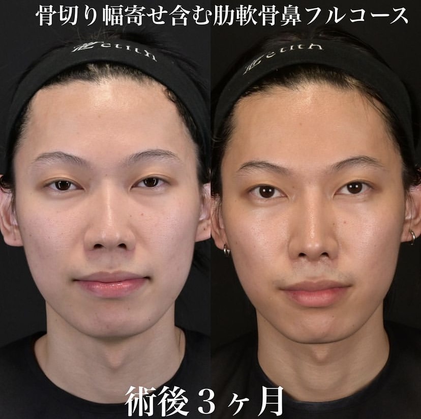 鉄医師による鼻整形の施術前／施術後3ヶ月