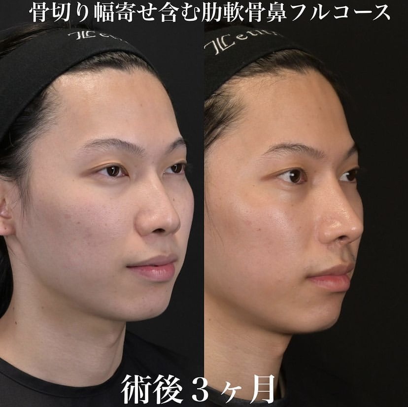 鉄医師による鼻整形の施術前／施術後3ヶ月 施術後 