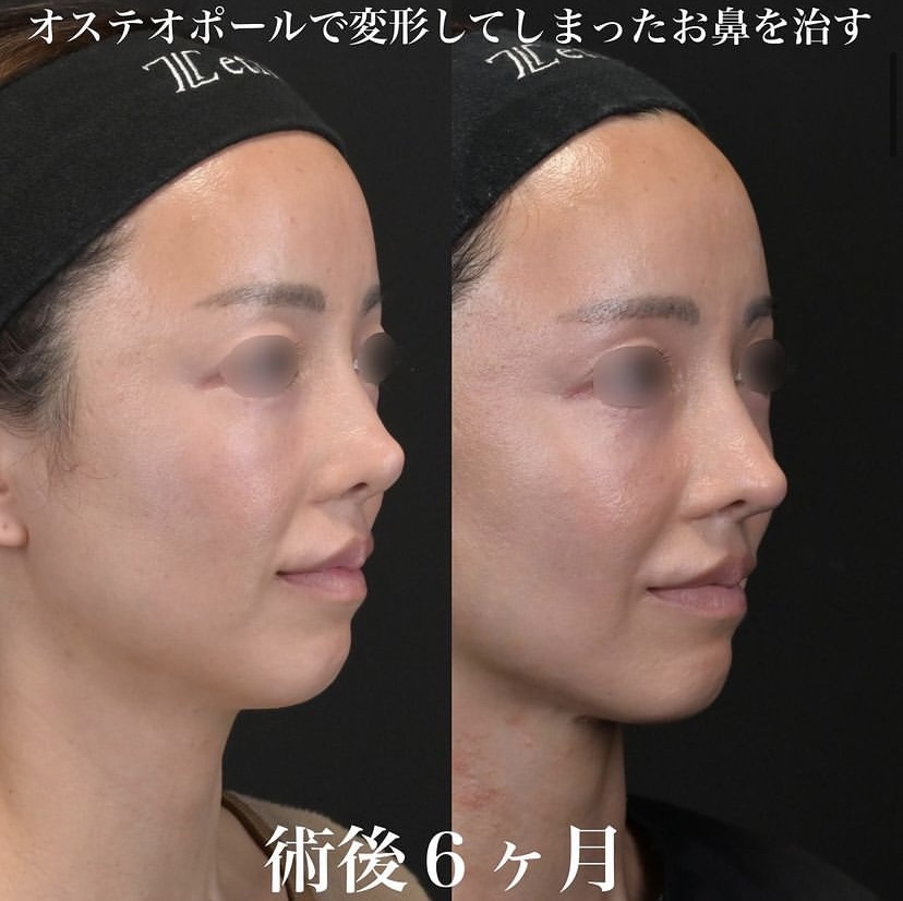 鉄医師による鼻整形の施術前／施術後6ヶ月