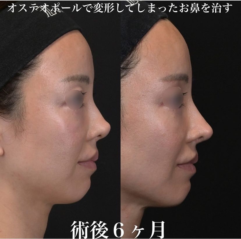 鉄医師による鼻整形の施術前／施術後6ヶ月 施術後 