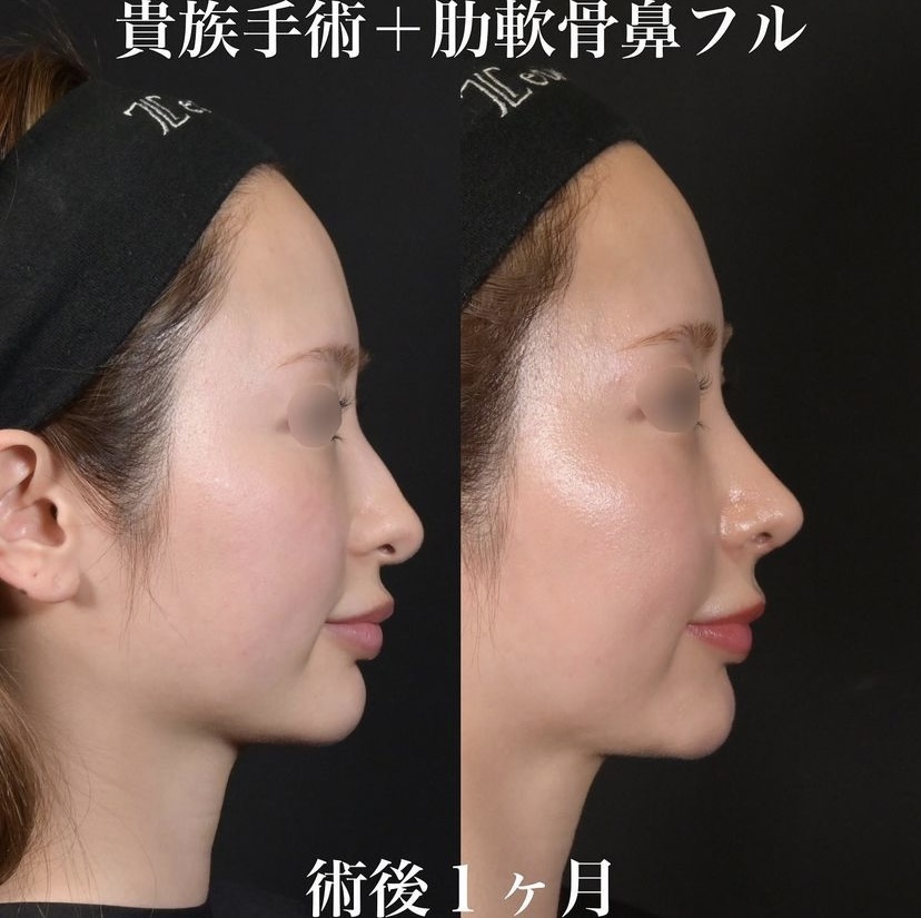鉄医師による鼻整形の施術前／施術後1ヶ月