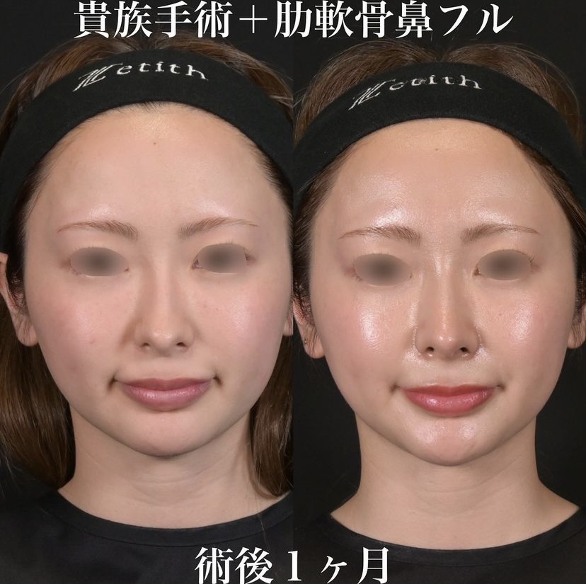 鉄医師による鼻整形の施術前／施術後1ヶ月 施術後 