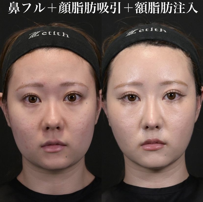 鉄医師による鼻整形の施術前／施術後1ヶ月