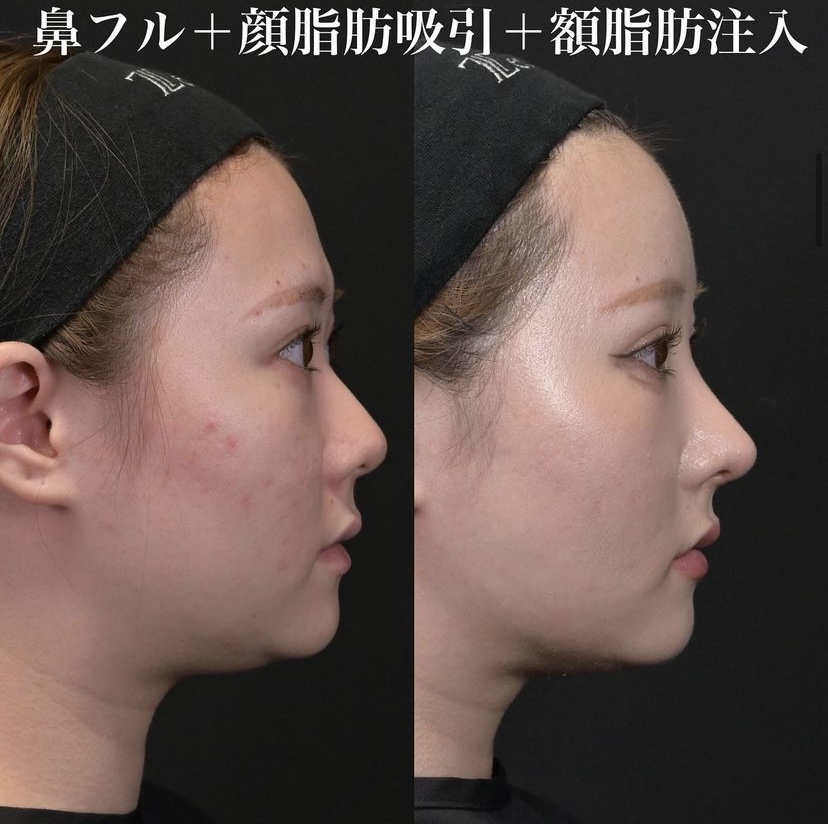 鉄医師による鼻整形の施術前／施術後1ヶ月 术后 