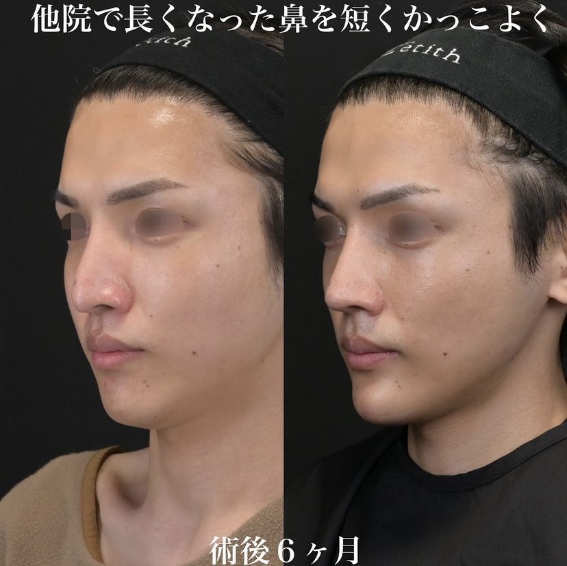 鉄医師による鼻整形の施術前／施術後6ヶ月