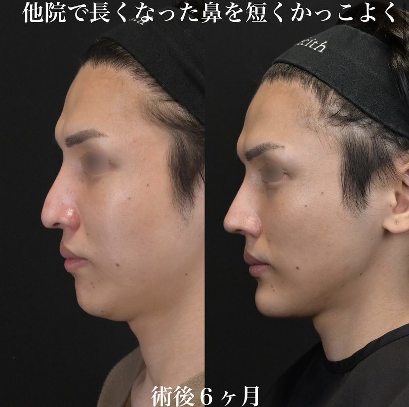 鉄医師による鼻整形の施術前／施術後6ヶ月 术后 