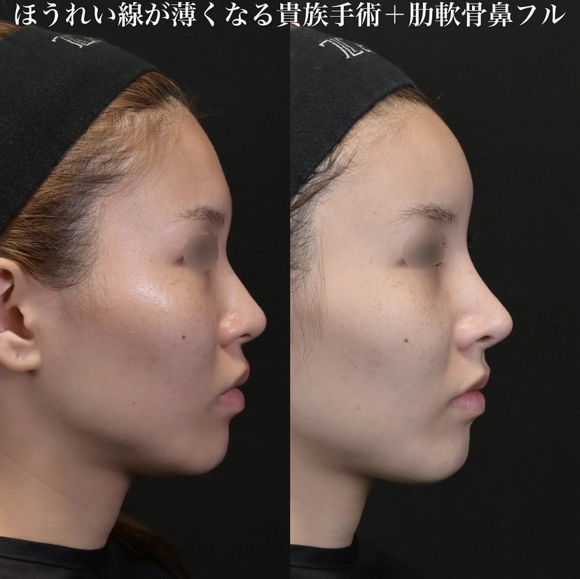鉄医師による鼻整形の施術前／施術後1ヶ月
