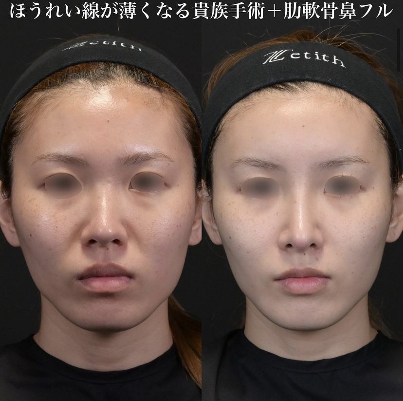 鉄医師による鼻整形の施術前／施術後1ヶ月 Дараа 