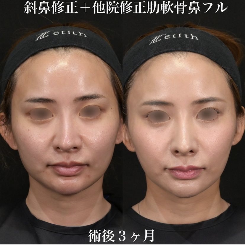 鉄医師による鼻整形の施術前／施術後3ヶ月