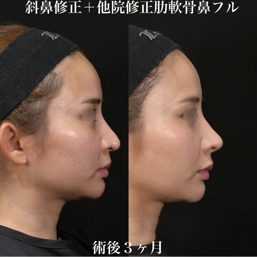 鉄医師による鼻整形の施術前／施術後3ヶ月 Дараа 
