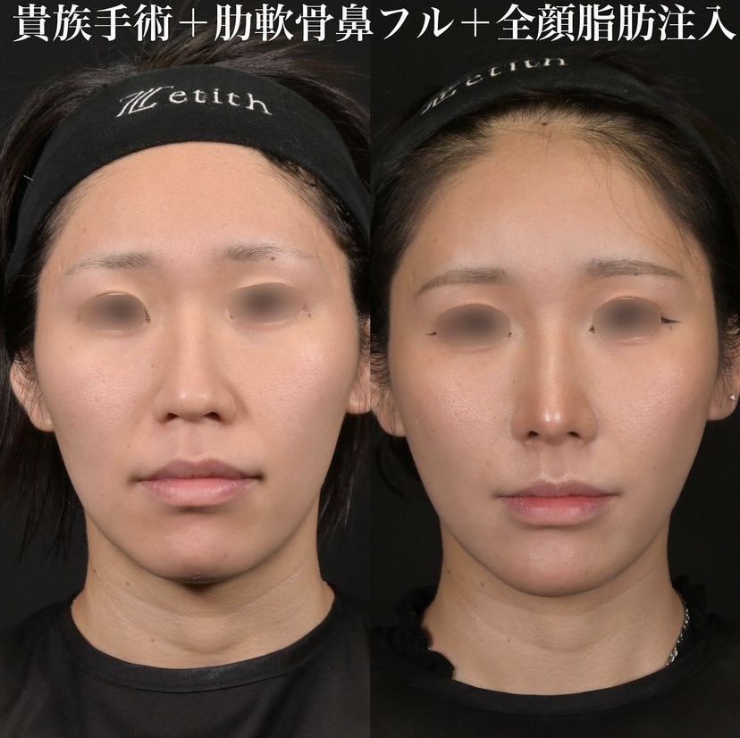 鉄医師による鼻整形の施術前／施術後1ヶ月