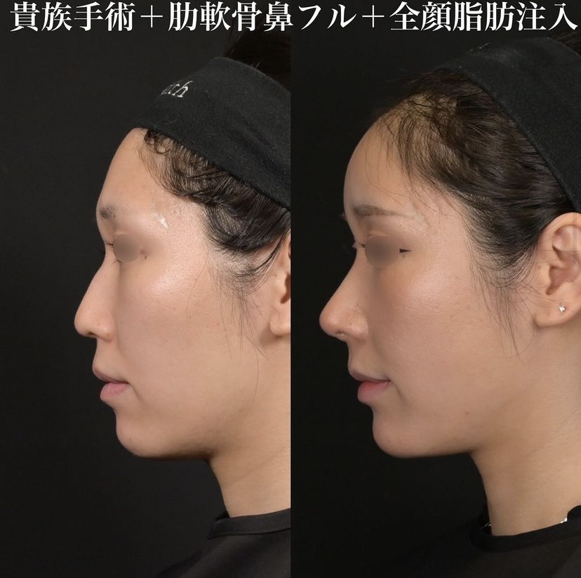 鉄医師による鼻整形の施術前／施術後1ヶ月 Sau 