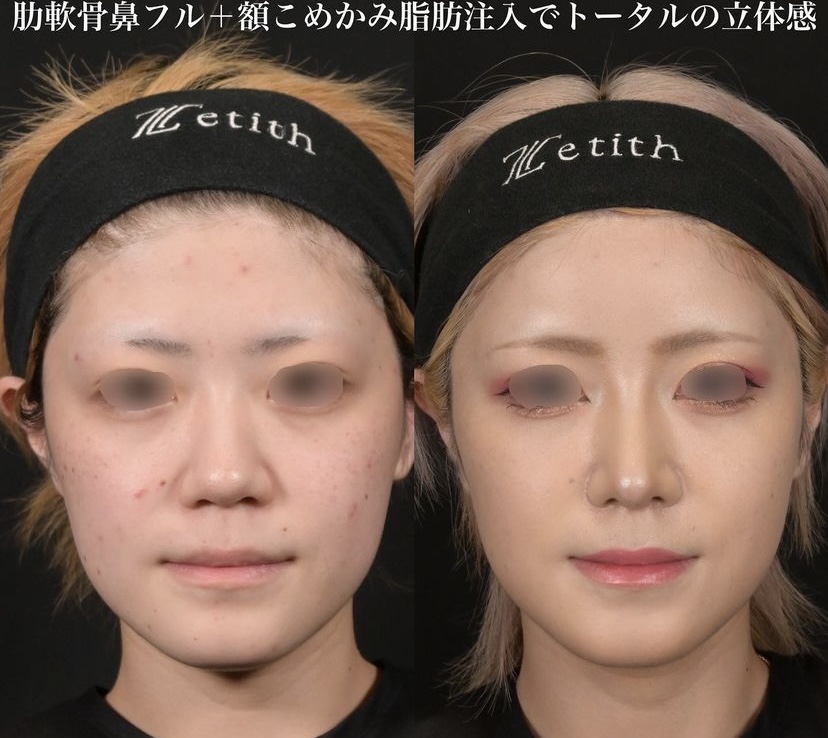 鉄医師による鼻整形の施術前／施術後1ヶ月