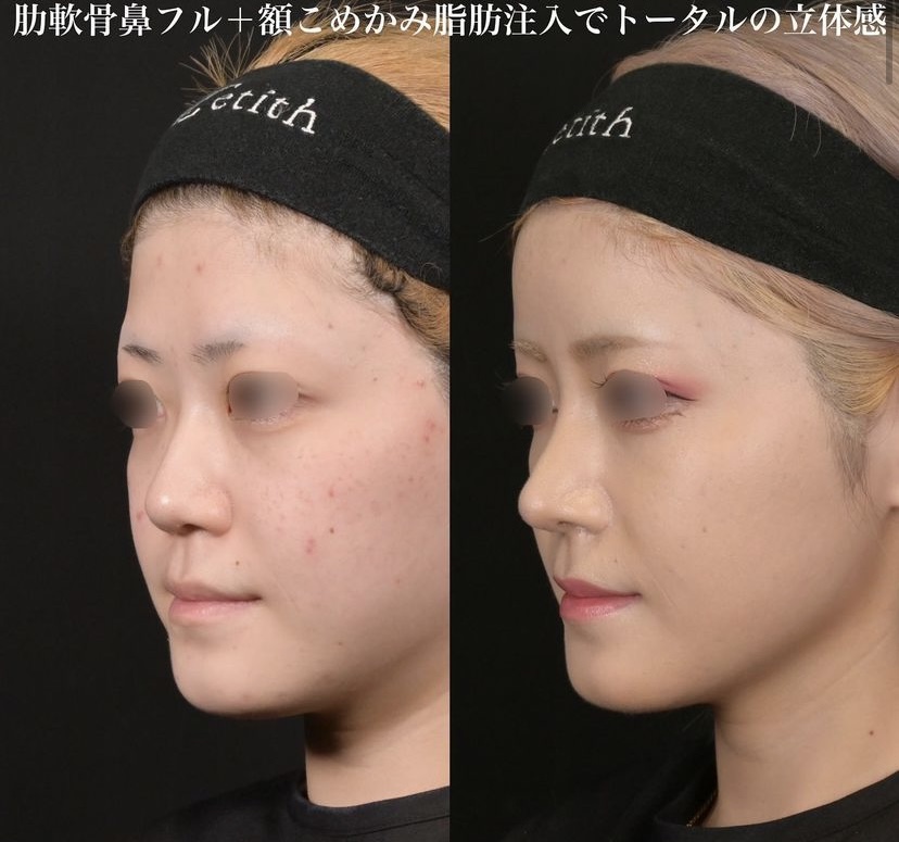 鉄医師による鼻整形の施術前／施術後1ヶ月 施術後 