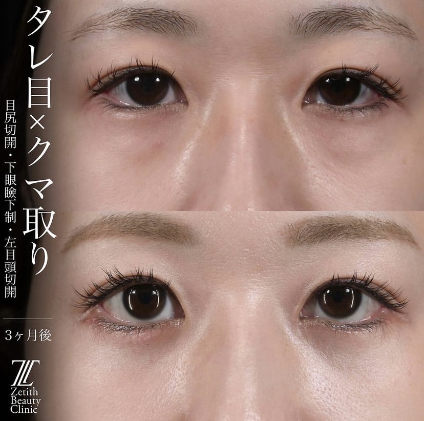 上木原医師による目元整形の施術前／施術後3ヶ月